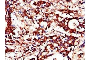Immunohistochemistry of paraffin-embedded human gastric cancer using ABIN7150756 at dilution of 1:100 (DUSP19 anticorps  (AA 1-217))