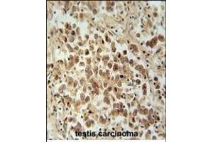VCX1 Antibody (N-term) (ABIN654781 and ABIN2844462) immunohistochemistry analysis in formalin fixed and paraffin embedded human testis carcinoma followed by peroxidase conjugation of the secondary antibody and DAB staining. (VCX anticorps  (N-Term))