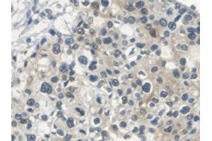 DAB staining on IHC-P; Samples: Human Prostate cancer Tissue