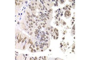 Immunohistochemistry of paraffin-embedded human colon carcinoma using SOX5 antibody. (SOX5 anticorps  (AA 1-120))