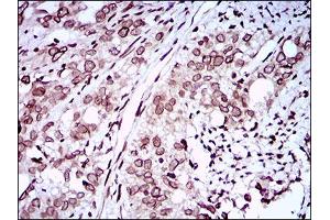 Immunohistochemical analysis of paraffin-embedded cervical cancer tissues using ZEB1 mouse mAb with DAB staining. (ZEB1 anticorps  (AA 967-1108))