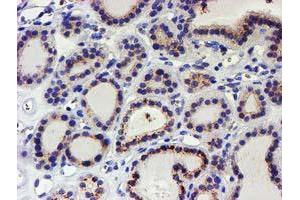 Immunohistochemical staining of paraffin-embedded Carcinoma of Human thyroid tissue using anti-KCNAB1 mouse monoclonal antibody. (KCNAB1 anticorps)
