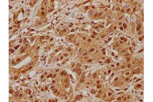IHC image of ABIN7139904 diluted at 1:100 and staining in paraffin-embedded human liver cancer performed on a Leica BondTM system. (AJUBA anticorps  (AA 61-77))
