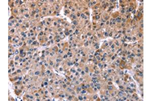 The image on the left is immunohistochemistry of paraffin-embedded Human liver cancer tissue using ABIN7128938(CHRM1 Antibody) at dilution 1/20, on the right is treated with fusion protein. (CHRM1 anticorps)