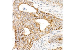 Immunohistochemistry of paraffin-embedded human colon carcinoma using L2 Rabbit pAb (ABIN7265513) at dilution of 1:50 (40x lens). (AFG3L2 anticorps  (AA 538-797))