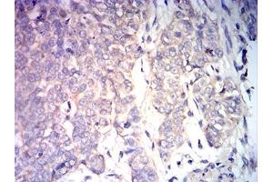 Immunohistochemical analysis of paraffin-embedded bladder cancer tissues using BAX mouse mAb with DAB staining. (BAX anticorps)