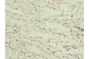 Immunohistochemistry of paraffin-embedded human gastric cancer using ABIN7160967 at dilution of 1:100