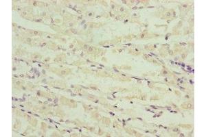 Immunohistochemistry of paraffin-embedded human gastric cancer using ABIN7160967 at dilution of 1:100 (NDUFS6 anticorps  (AA 29-124))