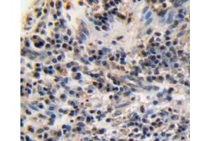 IHC-P analysis of esophagus cancer tissue, with DAB staining. (Ki-67 anticorps  (AA 3088-3235))