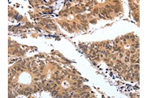 The image on the left is immunohistochemistry of paraffin-embedded Human colon cancer tissue using ABIN7130598(PGC Antibody) at dilution 1/25, on the right is treated with fusion protein. (PGC anticorps)