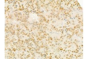 ABIN6264276 and ABIN6279342 at 1/100 staining human hepatocellular carcinoma by IHC-P. (PLA2G4F anticorps  (C-Term))