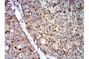 Immunohistochemical analysis of paraffin-embedded bladder cancer tissues using TRIM25 mouse mAb with DAB staining.