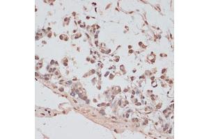 Immunohistochemistry of paraffin-embedded human gastric cancer using PRPF31 antibody (ABIN6132996, ABIN6146262, ABIN6146264 and ABIN6221399) at dilution of 1:100 (40x lens).