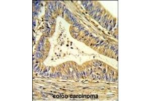 Formalin-fixed and paraffin-embedded human colon carcinoma reacted with SOD1 Antibody (Center), which was peroxidase-conjugated to the secondary antibody, followed by DAB staining. (SOD1 anticorps  (AA 55-84))