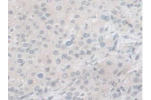 IHC-P analysis of Human Prostate Gland Cancer Tissue, with DAB staining. (PCSK1 anticorps  (AA 500-738))