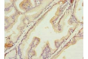 Immunohistochemistry of paraffin-embedded human prostate cancer using ABIN7156012 at dilution of 1:100