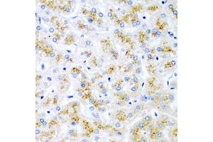 Immunohistochemistry of paraffin-embedded human liver damage using WNT2 antibody (ABIN6130801, ABIN6150239, ABIN6150241 and ABIN6221571) at dilution of 1:200 (40x lens). (WNT2 anticorps  (AA 26-360))
