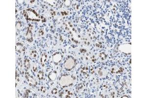 ABIN6267500 at 1/100 staining human Kidney carcinoma tissue sections by IHC-P.