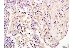 Formalin-fixed and paraffin embedded human lung (pneumonia) labeled with Anti-HAUSP/USP7 Polyclonal Antibody, Unconjugated (ABIN706346) at 1:200 followed by conjugation to the secondary antibody and DAB staining. (USP7 anticorps  (AA 801-897))