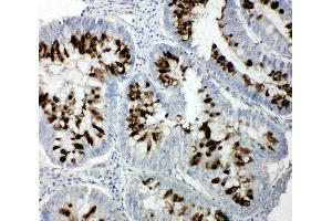 Anti-p107 antibody, IHC(P) IHC(P): Human Intestinal Cancer Tissue (p107 anticorps  (C-Term))