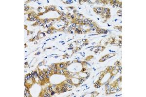 Immunohistochemistry of paraffin-embedded human colon carcinoma using PGRMC1 antibody.
