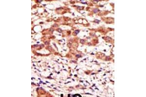Formalin-fixed and paraffin-embedded human cancer tissue reacted with the primary antibody, which was peroxidase-conjugated to the secondary antibody, followed by AEC staining.
