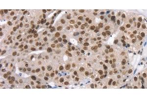 Immunohistochemistry of paraffin-embedded Human breast cancer using TAF15 Polyclonal Antibody at dilution of 1:35 (TAF15 anticorps)