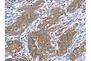 The image on the left is immunohistochemistry of paraffin-embedded Human cervical cancer tissue using ABIN7130635(PITPNM1 Antibody) at dilution 1/40, on the right is treated with fusion protein.
