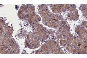 ABIN6272758 at 1/100 staining Human liver cancer tissue by IHC-P. (OR52H1 anticorps)