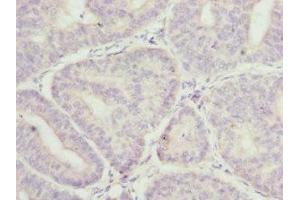 Immunohistochemistry of paraffin-embedded human endometrial cancer using ABIN7158931 at dilution of 1:100 (MR1 anticorps  (AA 20-260))