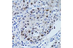 Immunohistochemistry of paraffin-embedded human lung cancer using UHRF1 antibody. (UHRF1 anticorps)