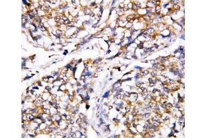 IHC-P: Caspase-4 antibody testing of human breast cancer tissue
