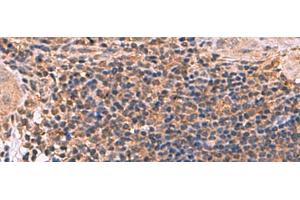 Immunohistochemistry of paraffin-embedded Human cervical cancer tissue using ZBTB33 Polyclonal Antibody at dilution of 1:30(x200) (ZBTB33 anticorps)