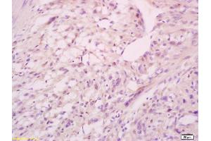Formalin-fixed and paraffin embedded human cervical carcinoma labeled with Anti-Phospho-MEF2A (Ser408) Polyclonal Antibody, Unconjugated (ABIN743783) at 1:200, followed by conjugation to the secondary antibody and DAB staining
