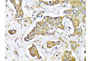 Immunohistochemistry of paraffin-embedded Human mammary cancer using MFGE8 antibody (ABIN6128291, ABIN6143792, ABIN6143794 and ABIN6215931) at dilution of 1:100 (40x lens).