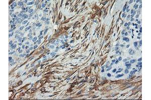 Immunohistochemical staining of paraffin-embedded Adenocarcinoma of Human breast tissue using anti-CNN2 mouse monoclonal antibody. (CNN2 anticorps)