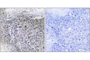 Immunohistochemistry analysis of paraffin-embedded human breast carcinoma tissue, using ZMY11 Antibody. (ZMYND11 anticorps  (AA 111-160))