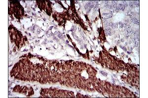 Immunohistochemical analysis of paraffin-embedded esophageal cancer tissues using CNN1 mouse mAb with DAB staining.