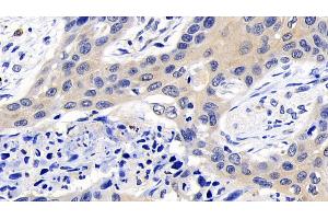 Detection of CASP8 in Human Lung cancer Tissue using Polyclonal Antibody to Caspase 8 (CASP8)