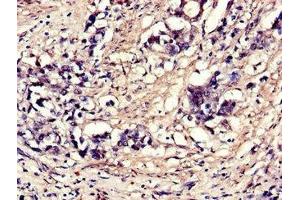 Immunohistochemistry of paraffin-embedded human gastric cancer using ABIN7152114 at dilution of 1:100