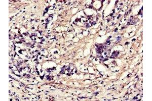 Immunohistochemistry of paraffin-embedded human gastric cancer using ABIN7152114 at dilution of 1:100 (EIF4A3 anticorps  (AA 6-166))
