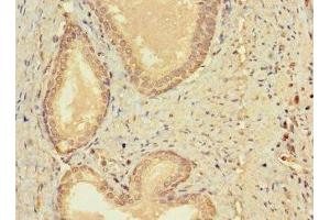 Immunohistochemistry of paraffin-embedded human prostate cancer using ABIN7147459 at dilution of 1:100 (CERKL anticorps  (AA 1-558))
