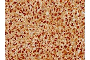 IHC image of ABIN7164153 diluted at 1:500 and staining in paraffin-embedded human glioma performed on a Leica BondTM system.