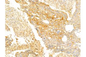 FAM92A1 Antibody at 1/100 staining Human lung cancer by IHC-P. (FAM92A1 anticorps  (C-Term))