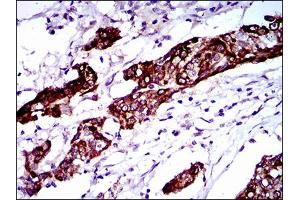 Immunohistochemical analysis of paraffin-embedded esophagus cancer tissues using BRCA1 mouse mAb with DAB staining.