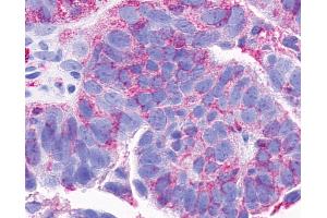 Anti-CCRL2 antibody IHC of human Ovary, Carcinoma.