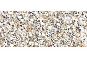 Immunohistochemistry of paraffin-embedded Human prostate cancer using NME2 Polyclonal Antibody at dilution of 1/40