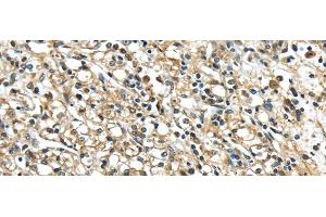 Immunohistochemistry of paraffin-embedded Human prostate cancer using NME2 Polyclonal Antibody at dilution of 1/40
