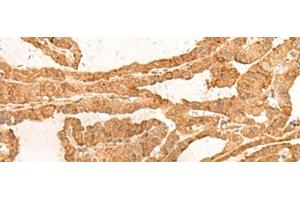 Immunohistochemistry of paraffin-embedded Human thyroid cancer tissue using ZBTB8A Polyclonal Antibody at dilution of 1:100(x200) (ZBTB8A anticorps)