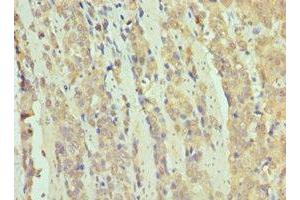 Immunohistochemistry of paraffin-embedded human colon cancer using ABIN7171070 at dilution of 1:100